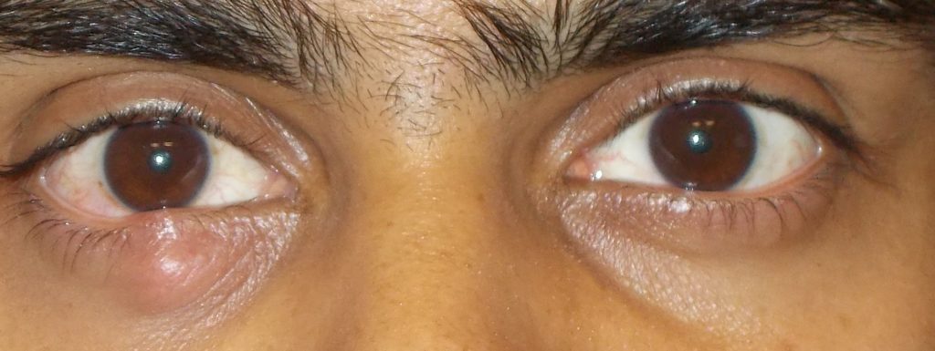 Chalazion on the Right Lower Eyelid