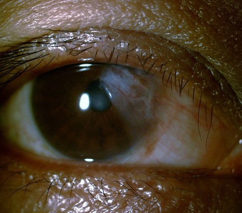 Pterygium from Excessive Ultraviolet Exposure