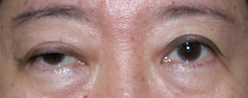 Right Eyelid Ptosis