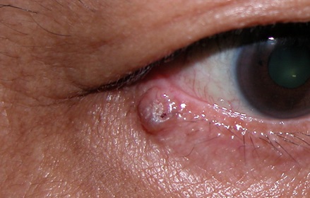 Lumps and bumps on the eyelids - Non infection types/tumours