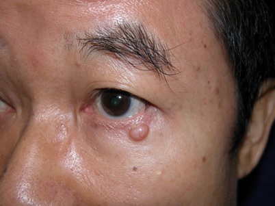 Lumps and bumps on the eyelids - Non infection types/tumours